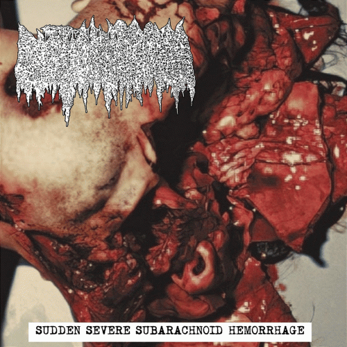 Cystic Hygroma : Sudden Severe Subarachnoid Hemorrhage